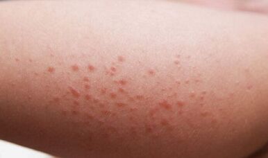 manifestações externas da presença de parasitas no corpo